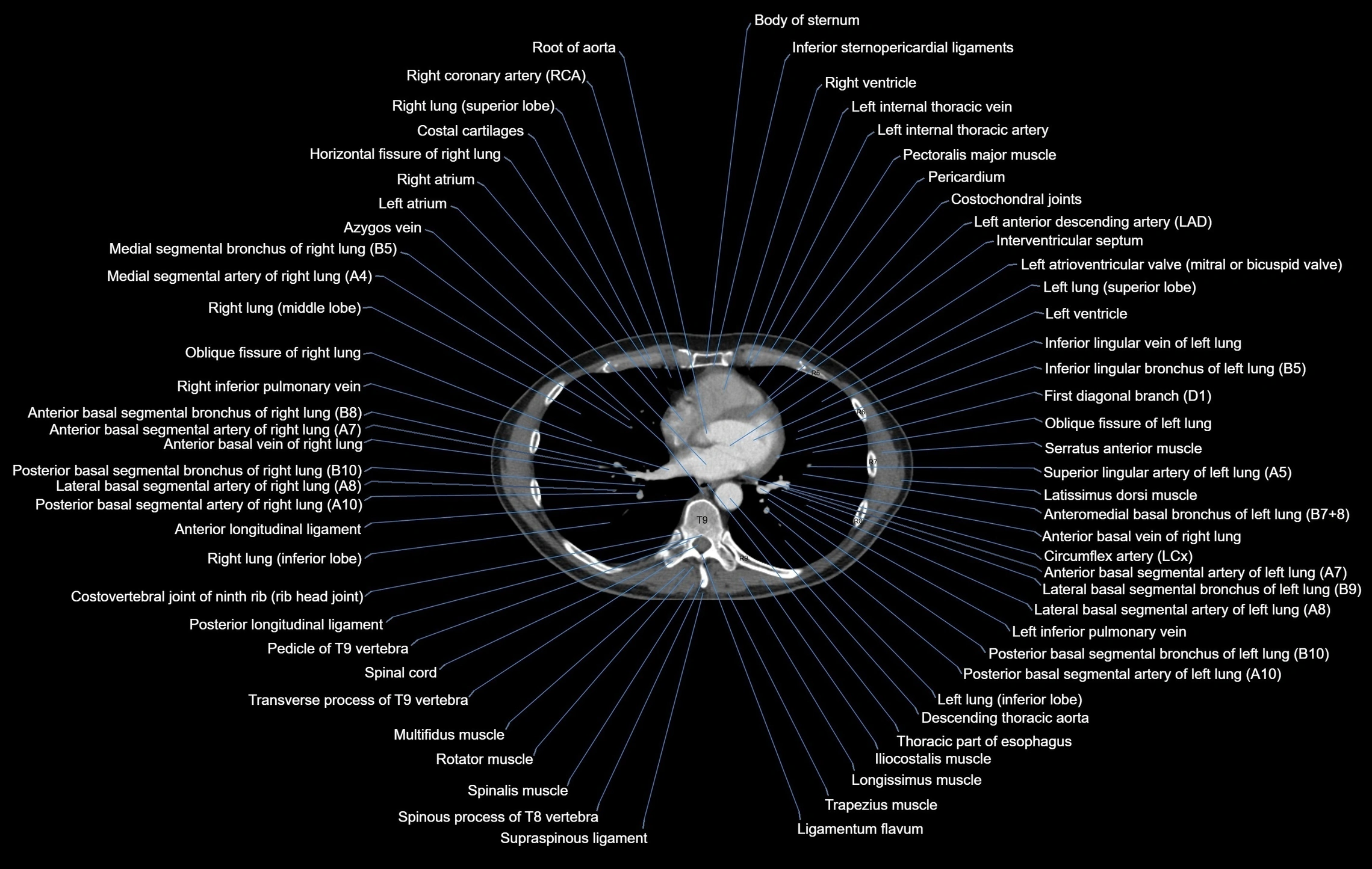 CT chest (thorax) labelled axial cross sectional anatomy radiology image-00076.webp